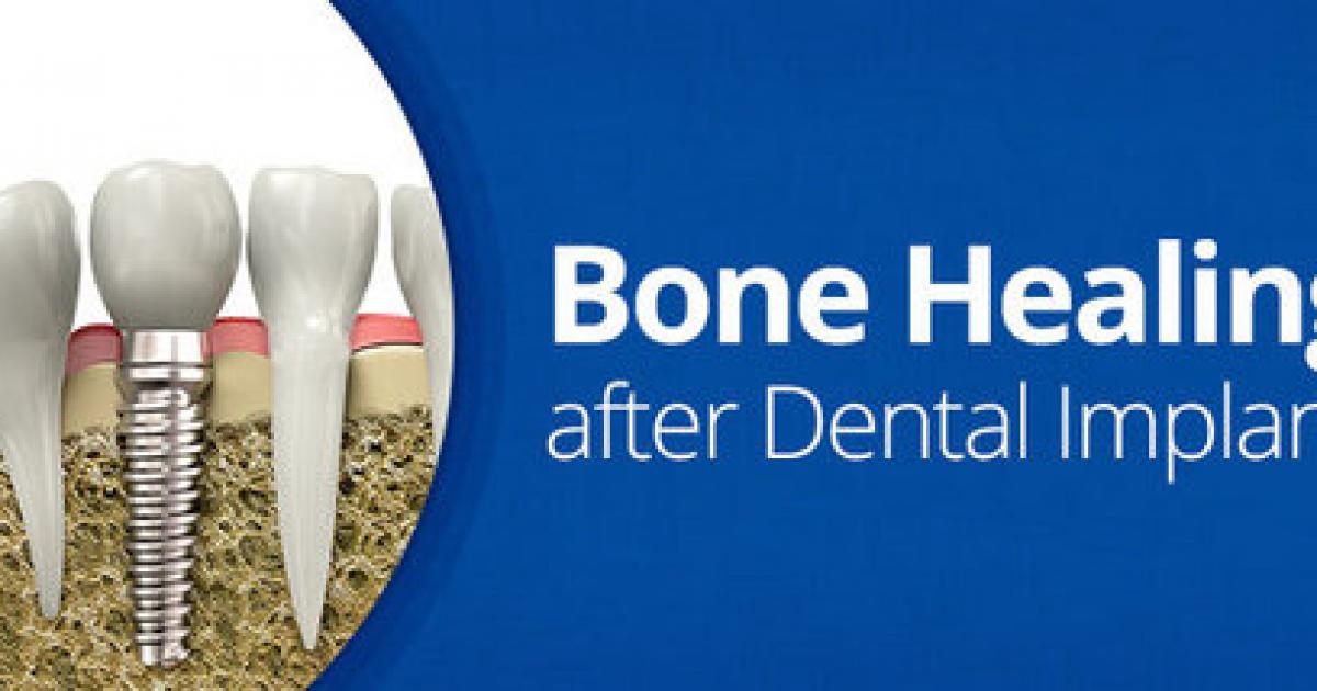 Dental implants the bone needs time to heal