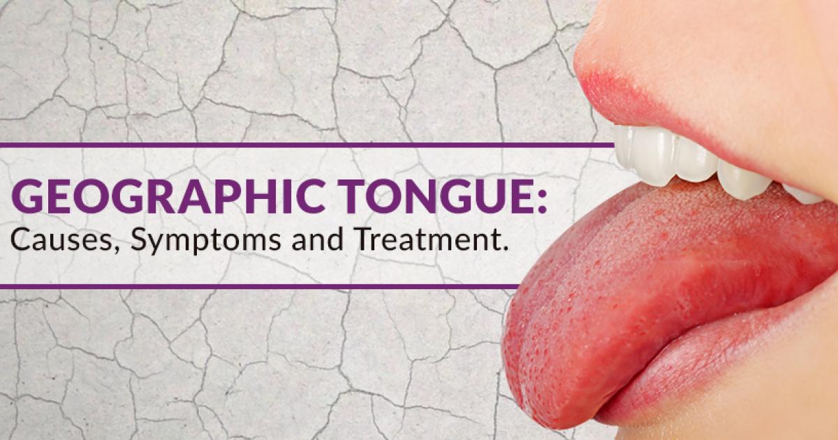 Geographic Tongue Causes, Symptoms and Treatments