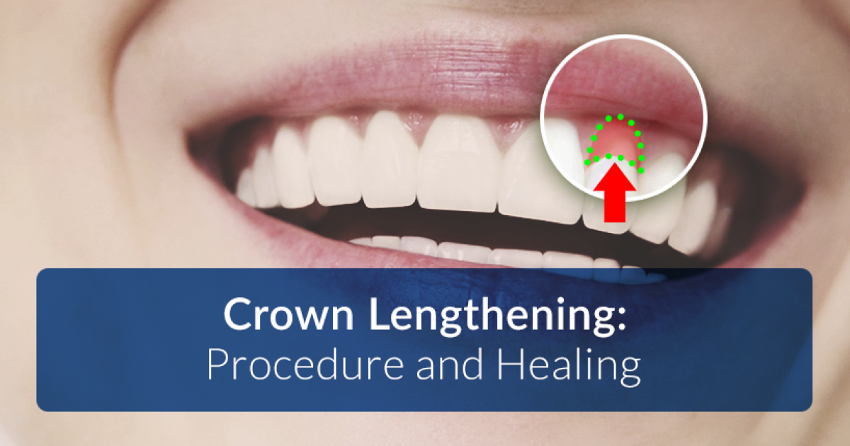 Crown Lengthening Procedure and Healing