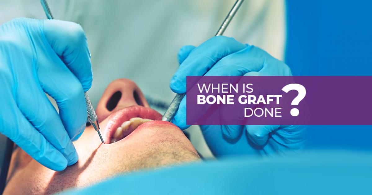 What Are Dental Bone Grafts?