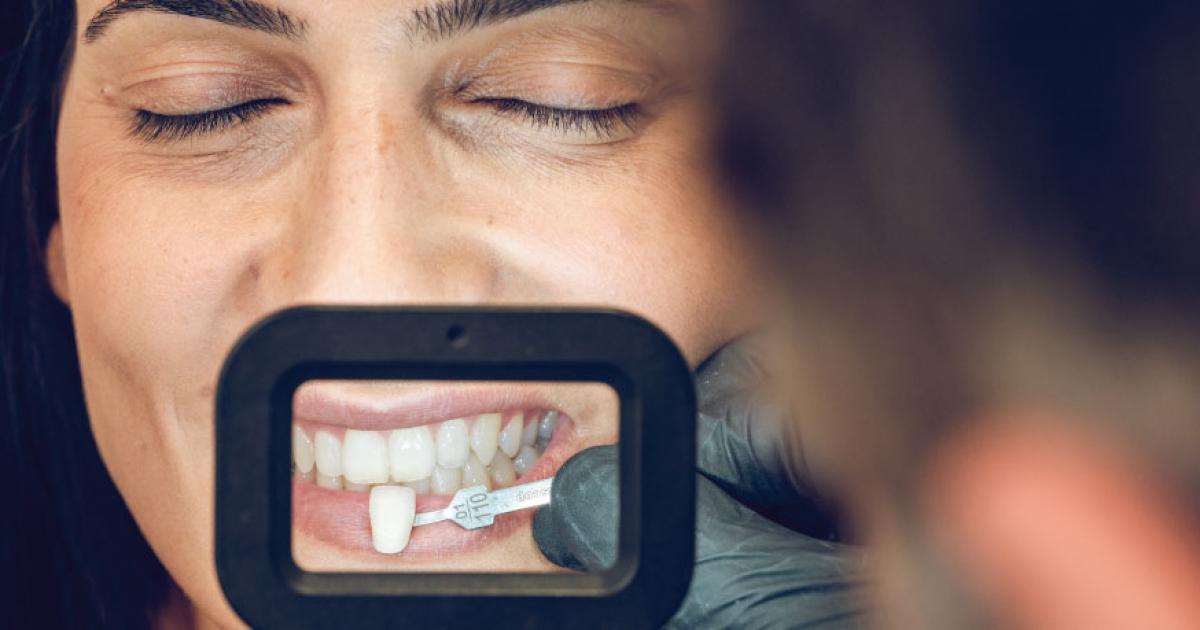 Dental Veneers How they work